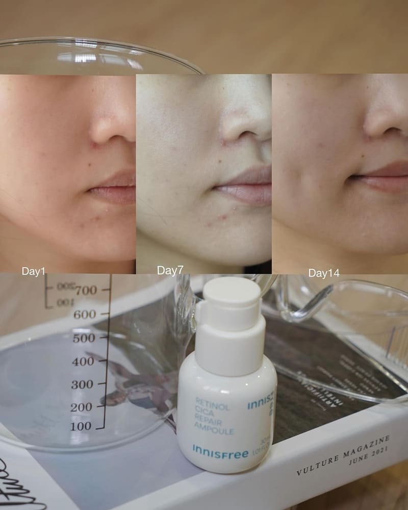 「A醇淨膚超修護安瓶」Innisfree敏弱問題肌|解決痘痘迴戰、打造光滑、水嫩肌膚!